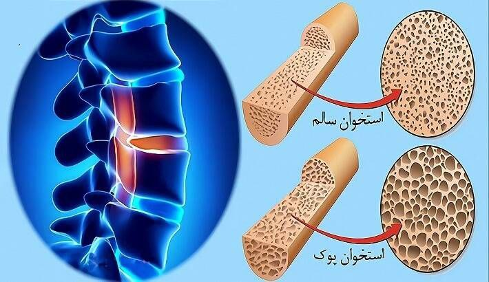 پوکی استخوان؛ بیماری خاموش و مزمن