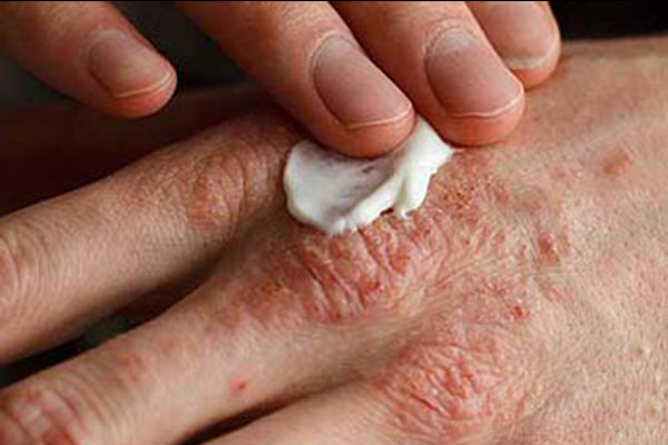 هوای آلوده خطر اگزما را افزایش می‌دهد